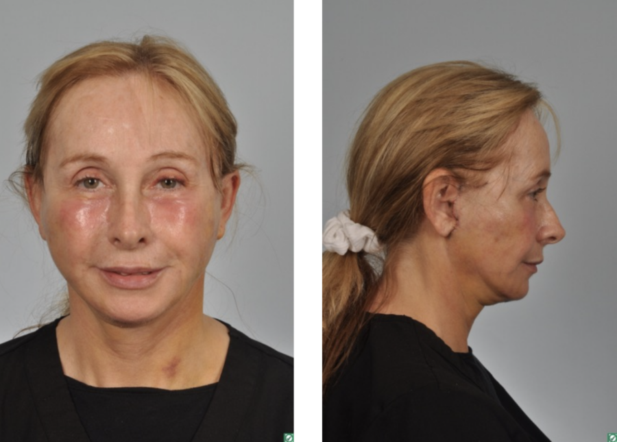 woman 1 week after face and neck lift